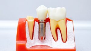 Implant zębowy